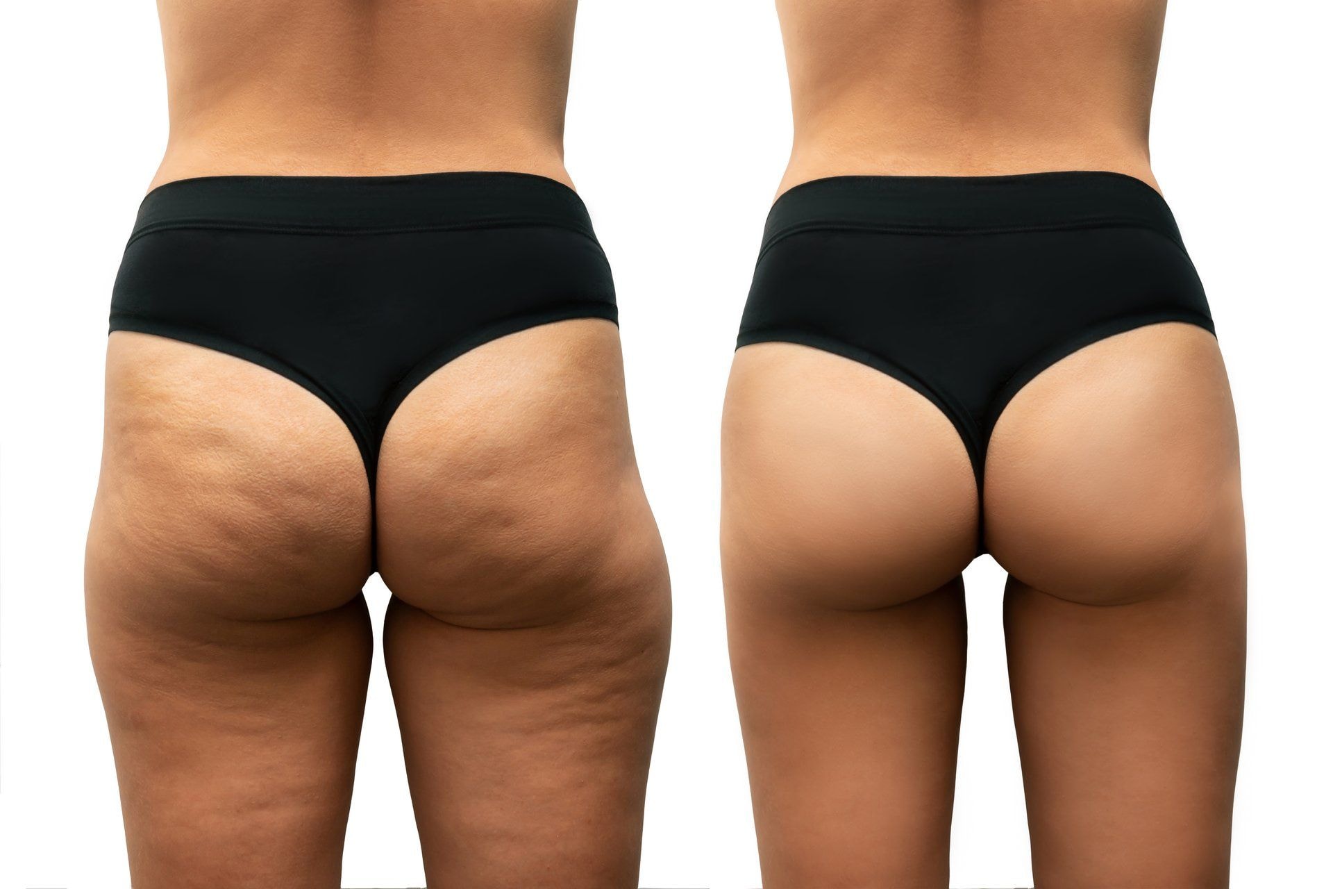 Vergleich einer Cellulite